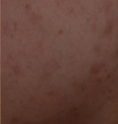 自己祛痘印最好方法快速祛除痘坑,怎么能更有效的祛痘印呢