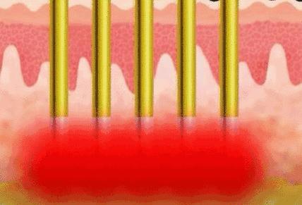 医美微针有什么效果,配合微针做的医美产品有哪些