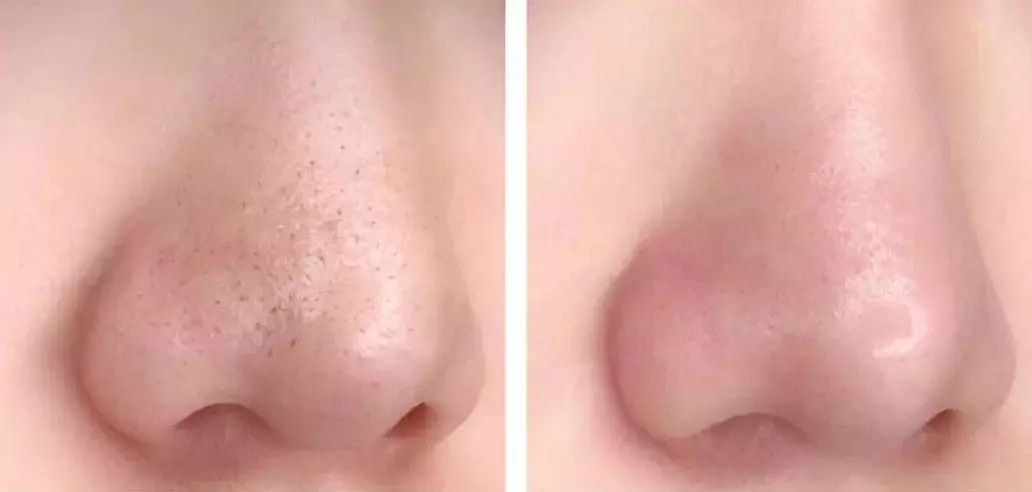 去多年顽固黑头,长了一年的黑头怎么去除