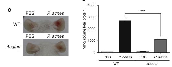 打一针治痘痘！科学家使用免疫疗法开发*疮痤**疫苗，有望战痘成功｜科学大发现