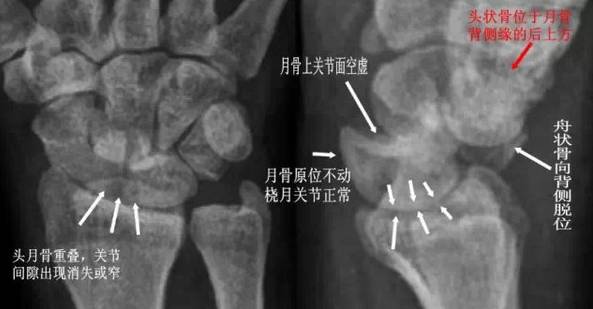 青少年尺腕关节脱位x线诊断标准,腕关节侧位x线片读片技巧