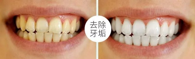 牙黄口臭用什么牙膏有效果一点,烟黄牙洗牙能洗白吗
