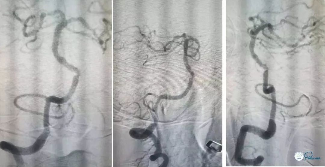 椎动脉狭窄介入手术病例汇报,基底动脉狭窄70%的介入治疗
