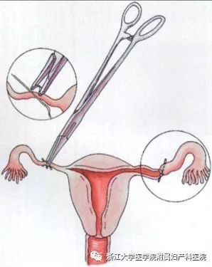 超级值得收藏的避孕方式大盘点：“老司机们，请安全驾驶！”