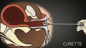 多次打胎真实案例,25岁女生接受多少次打胎