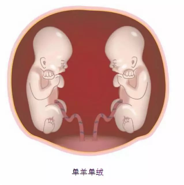 40岁生双胞胎的风险,双胞胎风险真的很大吗