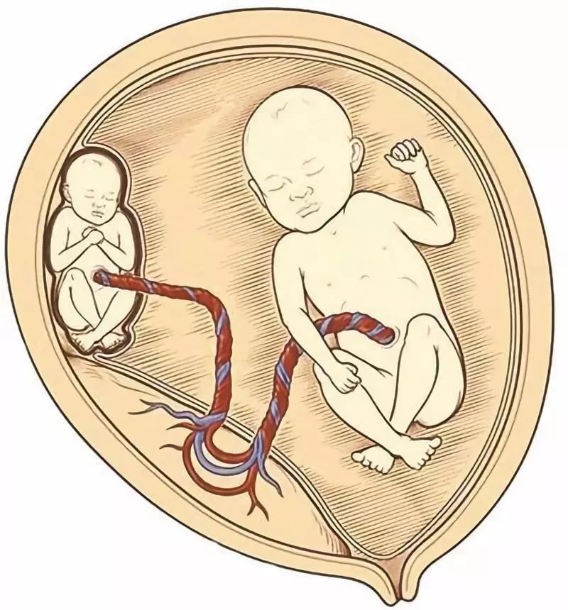 40岁生双胞胎的风险,双胞胎风险真的很大吗
