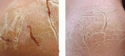 治脚气的抗真菌偏方,角化型脚气干裂最好的药