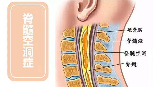 痛温觉障碍说明什么,脊髓空洞症的感觉障碍表现