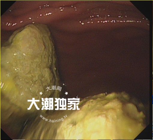 「925丨提醒」男子体内长了两大团……医生却说：快喝可乐！喝一个星期！