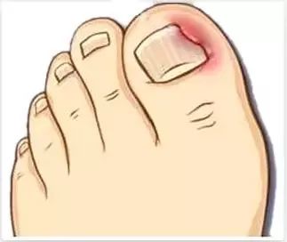 十六岁女孩六年不剪脚趾甲,11岁女孩没有剪过指甲