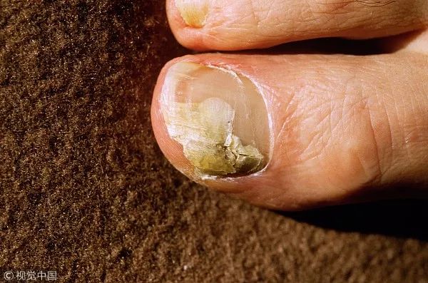 十六岁女孩六年不剪脚趾甲,11岁女孩没有剪过指甲