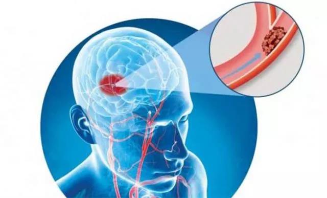 小孩会得中风吗,小孩会得脑中风吗