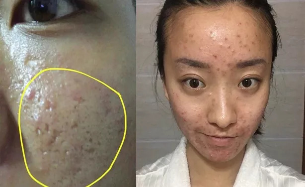 斑疤痘敏妊娠纹,伤痕印如何能快速消除
