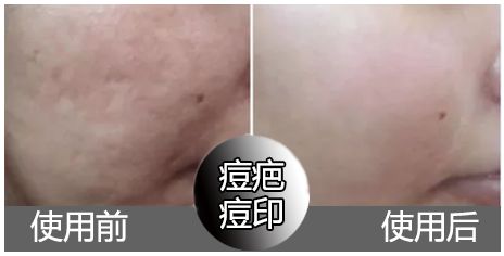 斑疤痘敏妊娠纹,伤痕印如何能快速消除