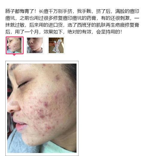 斑疤痘敏妊娠纹,伤痕印如何能快速消除