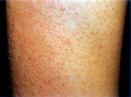 一招告别鸡皮肤养成光滑肌,摆脱鸡皮肤超简单