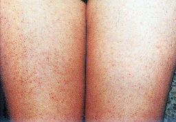 一招告别鸡皮肤养成光滑肌,摆脱鸡皮肤超简单