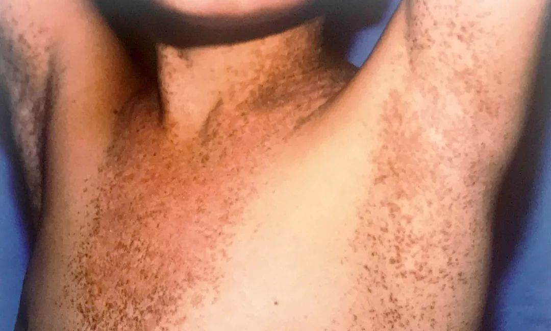 一招告别鸡皮肤养成光滑肌,摆脱鸡皮肤超简单