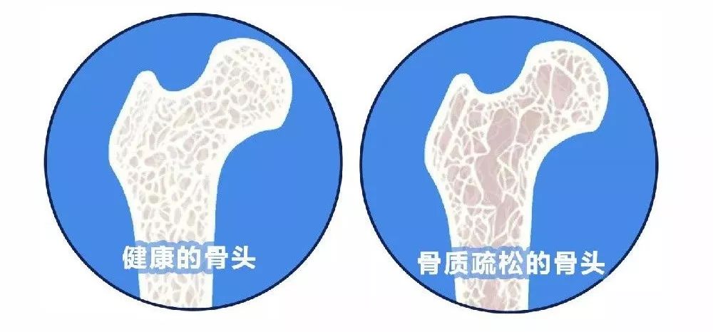 打了个喷嚏肋骨断了,打了个喷嚏把腰扭了咋办