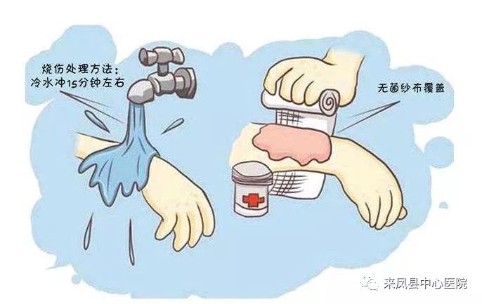 烧伤后抹酱油洒草灰，No！正确处理方式看这里
