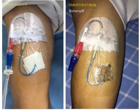 picc穿刺处渗血的预防和处理,picc穿刺部位渗血图片