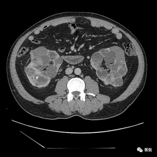 肾功能不全双肾回声稍增强怎么办,肾ct检查双肾萎缩