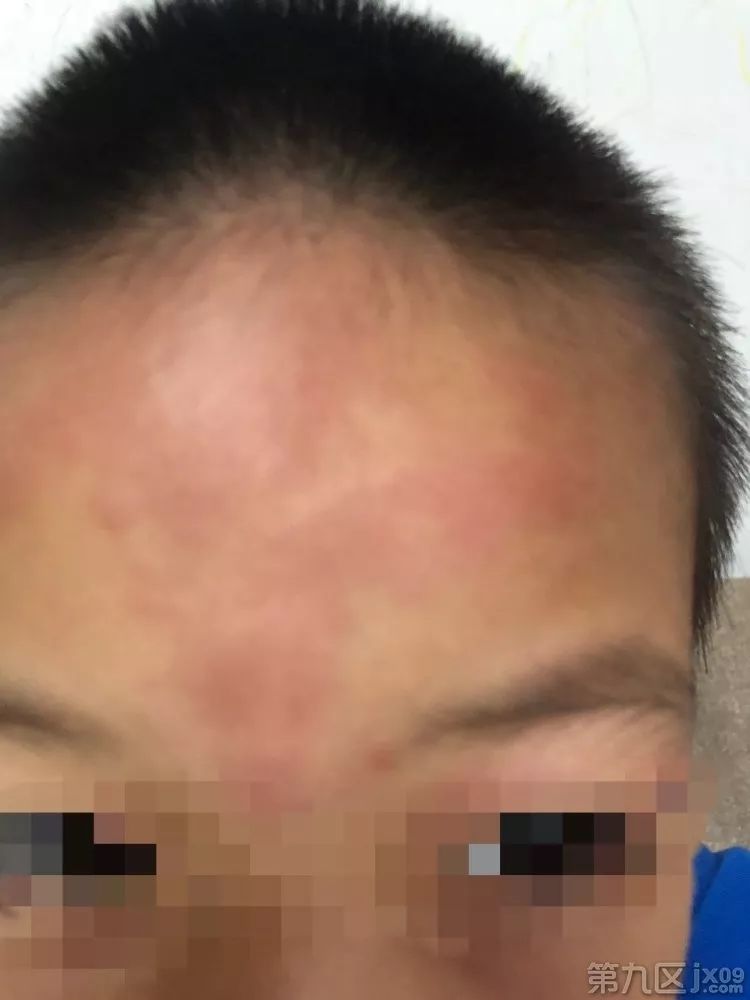 孩子吃感冒药过敏起了红疹图片,孩子吃感冒药后脸上有红点点