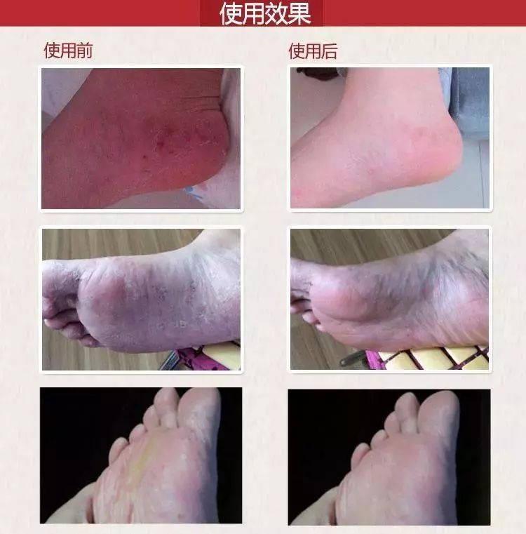 泰国治癣的药膏排行榜,泰国治疗皮肤癣的药膏