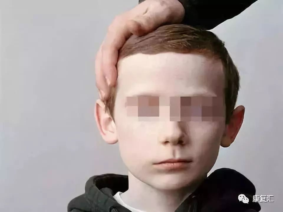 康复科治疗面瘫效果怎么样,面瘫康复训练评分