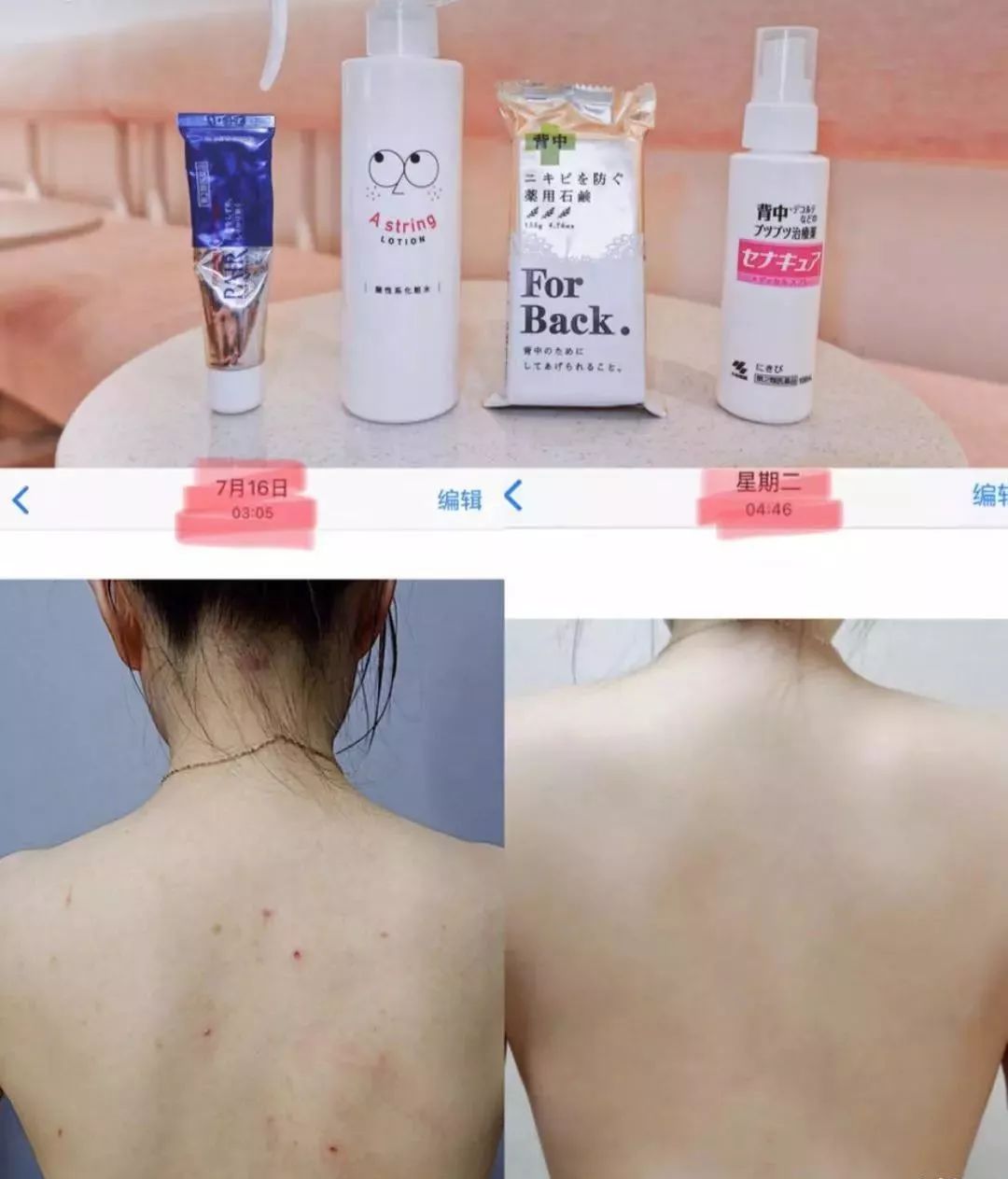 红肿，流脓的万年毒痘一喷全消失？岛国新晋痘肌终结者！彻底祛痘不反复！