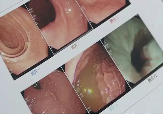 吃栗子多了会恶心反胃吗,吃栗子导致反酸水