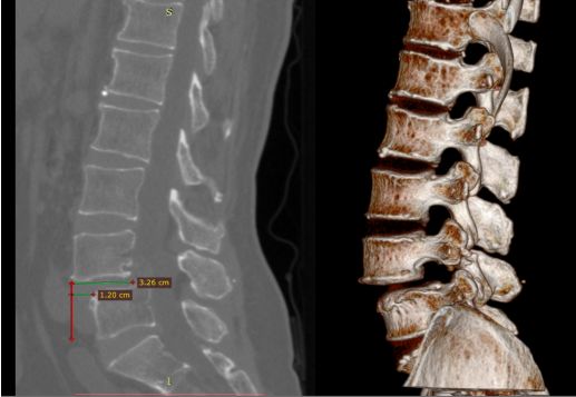 骨水泥治疗老年压缩性腰椎骨折,骨水泥治疗骨质疏松脊柱骨折