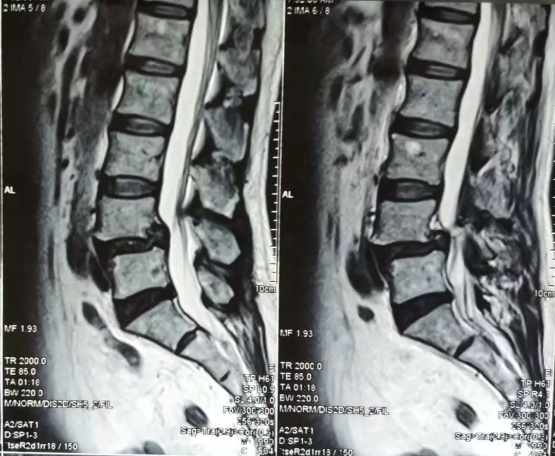 骨水泥治疗老年压缩性腰椎骨折,骨水泥治疗骨质疏松脊柱骨折