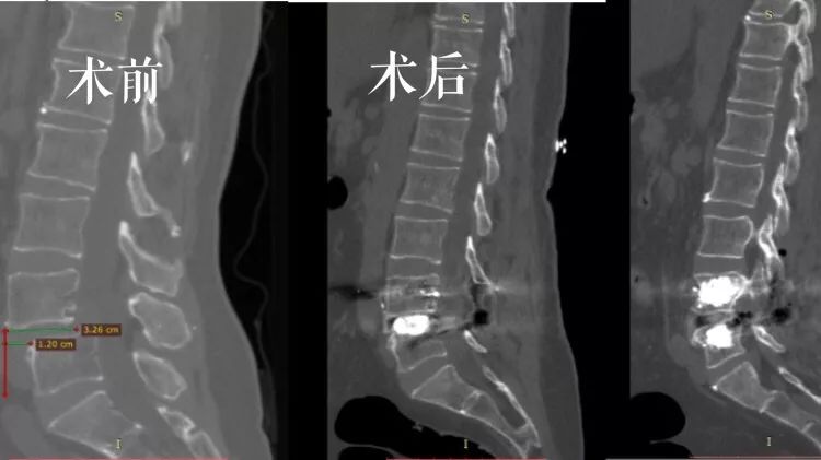 骨水泥治疗老年压缩性腰椎骨折,骨水泥治疗骨质疏松脊柱骨折