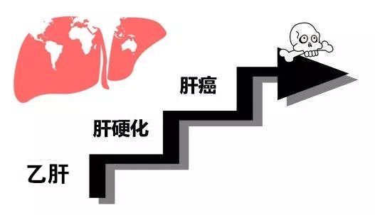专家科普从乙肝到肝癌总共分几步,健康科普乙肝离肝癌到底有多远