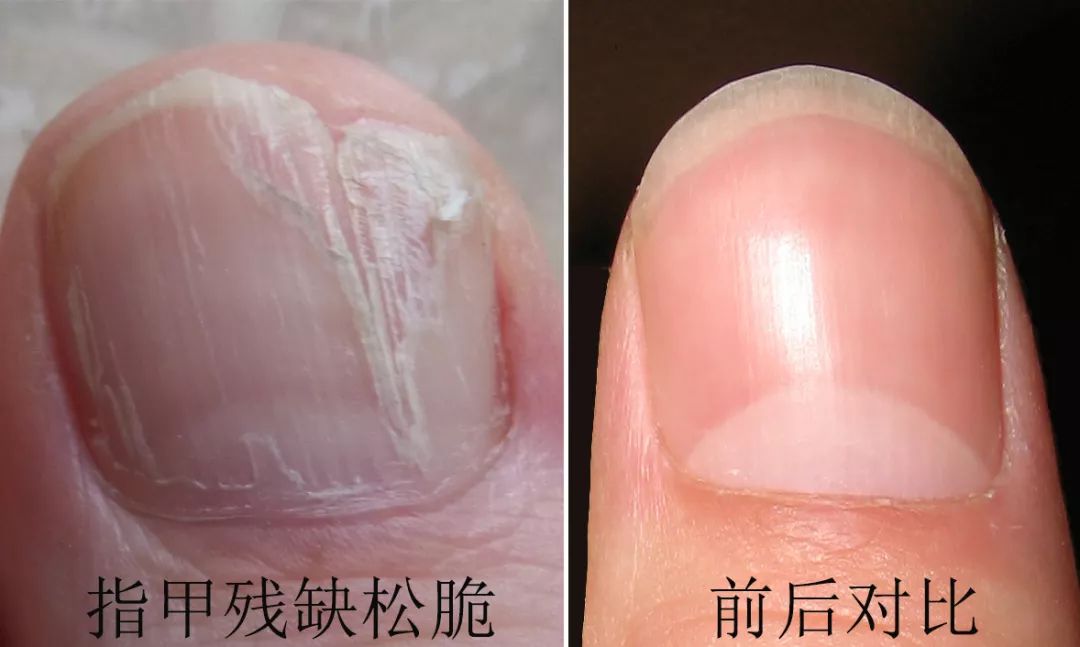 灰指甲的治愈之路你值得拥有,10年顽固灰指甲久治不愈