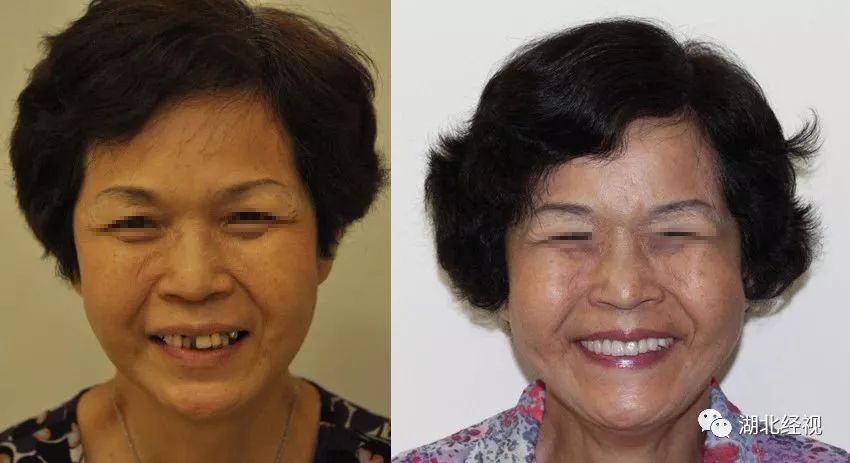 全城征集免费种植牙,全城征集免费种牙