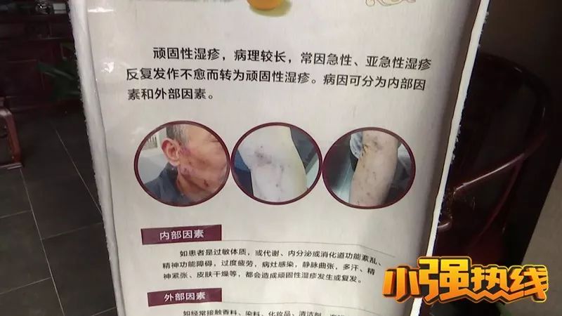 湿疹孩子成功治愈案例,女儿湿疹终于好了