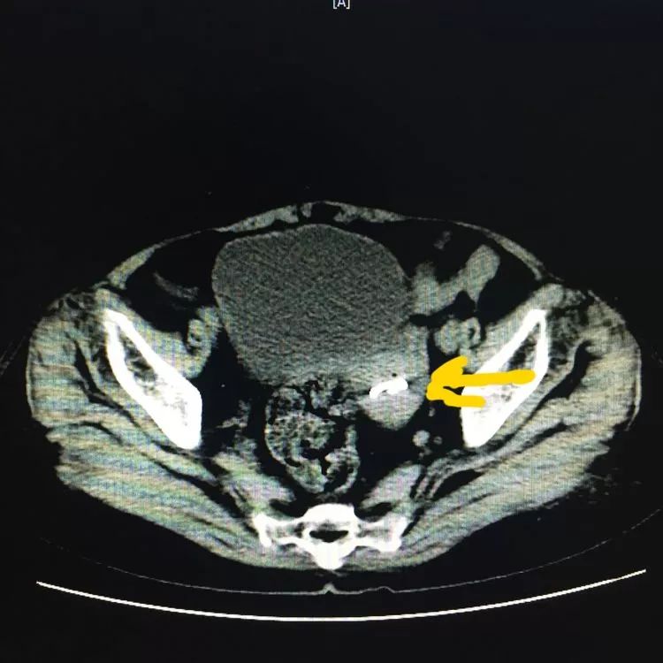 宫内节育器y型,渭北宫内节育器