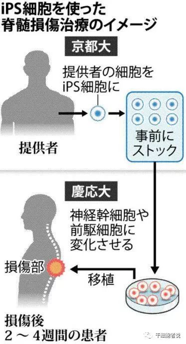 日本干细胞治疗脑卒中病人,日本干细胞治疗脊髓损伤的进展
