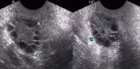 卵巢功能减退可以怀孕吗,卵巢储备功能降落会怀孕吗