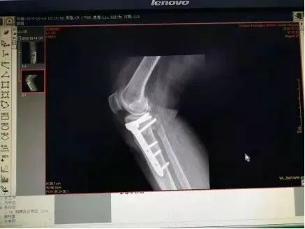 膝关节置换是微创还是开刀,膝关节置换必须要用助行器吗