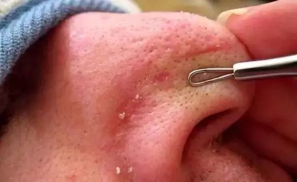 去多年顽固黑头,长了一年的黑头怎么去除