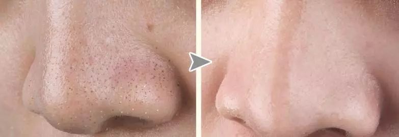 去多年顽固黑头,长了一年的黑头怎么去除