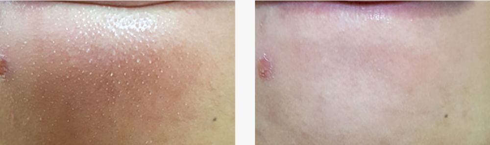 去多年顽固黑头,长了一年的黑头怎么去除