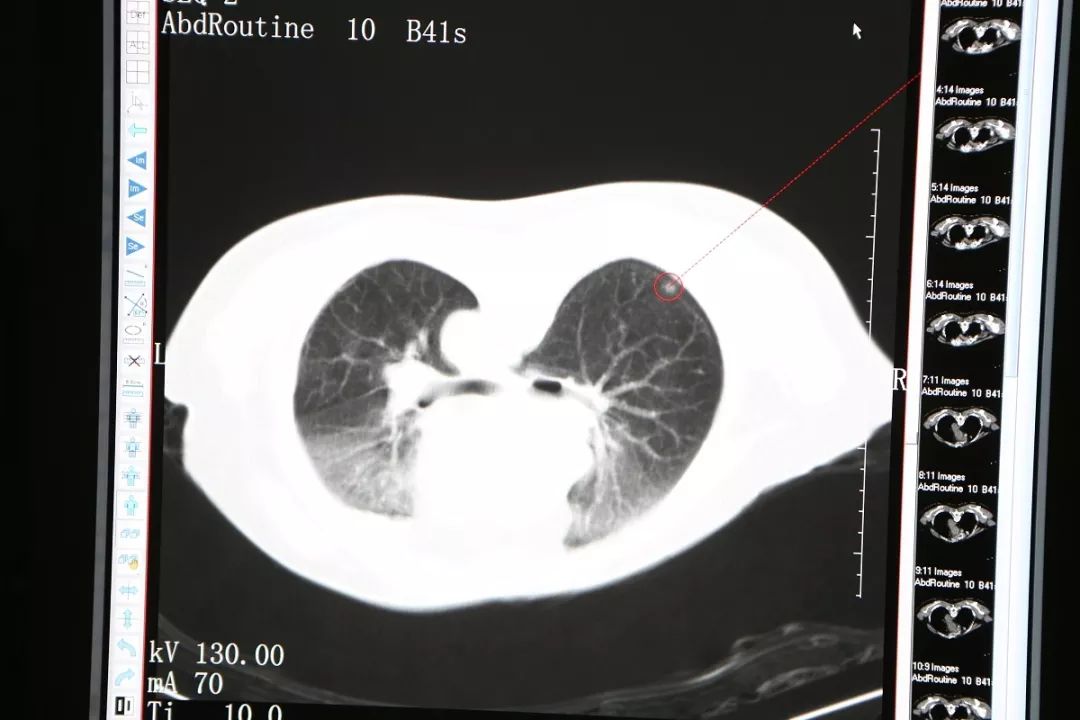 一根消融针能消融多少结节,一根针杀灭癌细胞