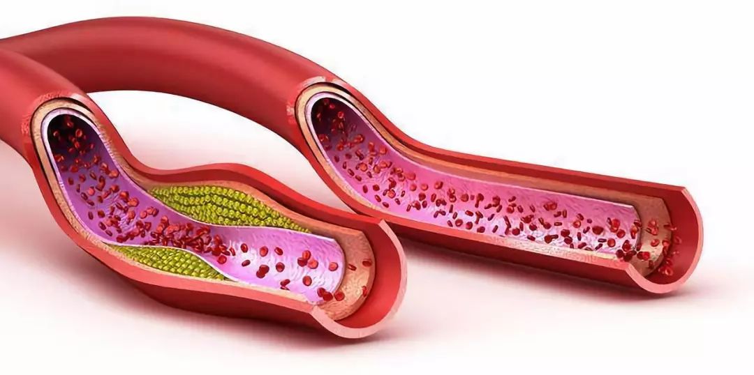 快速调理三高的方法,如何治疗三高症