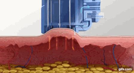 医美微针有什么效果,配合微针做的医美产品有哪些