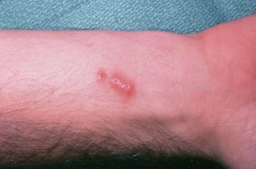 腋下肿大伴有疼痛感发烧,90后女孩40度高烧